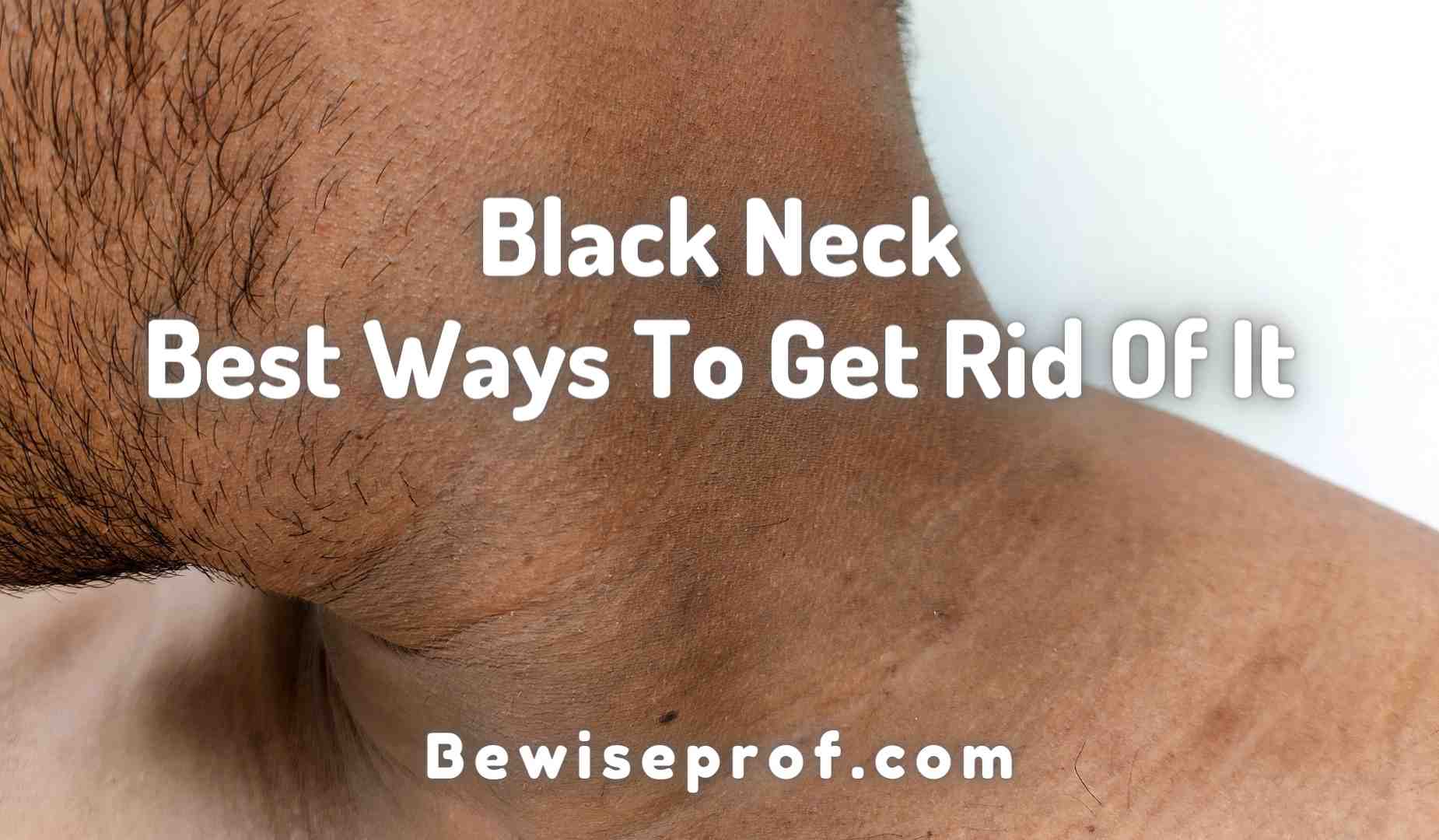 Black Neck – Best Ways To Get Rid Of It