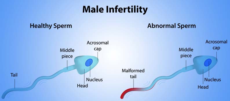 Male Infertility: Explanations, Solution And Prevention