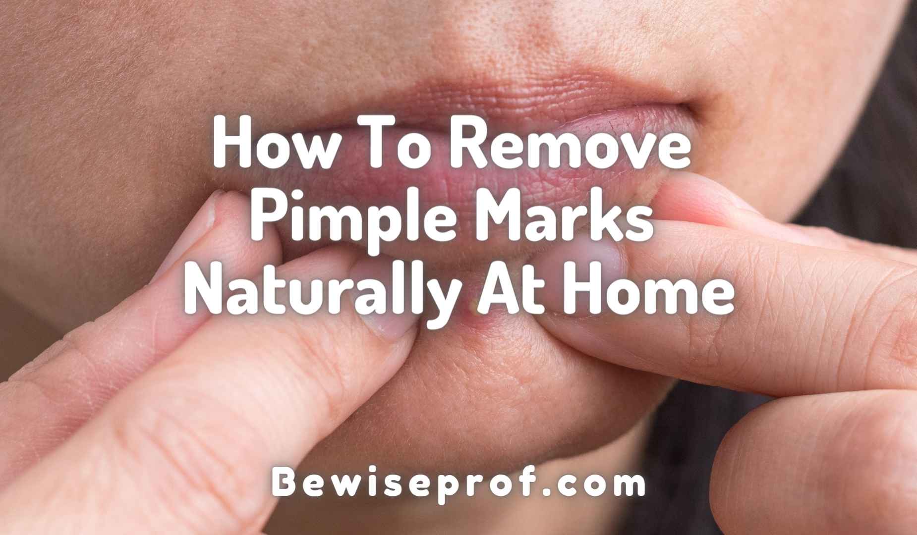 How To Get rid of Pimple Marks In a natural way At Dwelling
